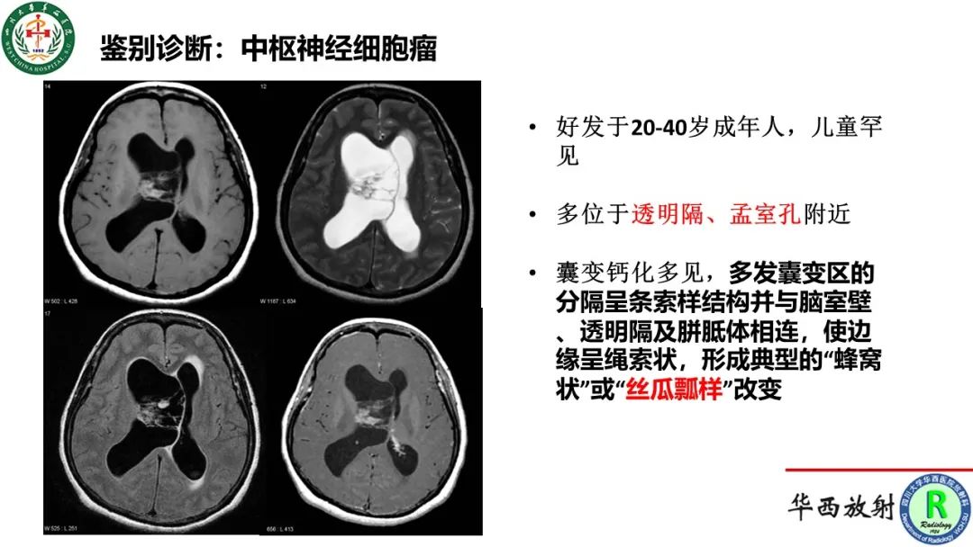 影像PPT - 【病例】侧脑室囊性脑膜瘤1例MR影像-14