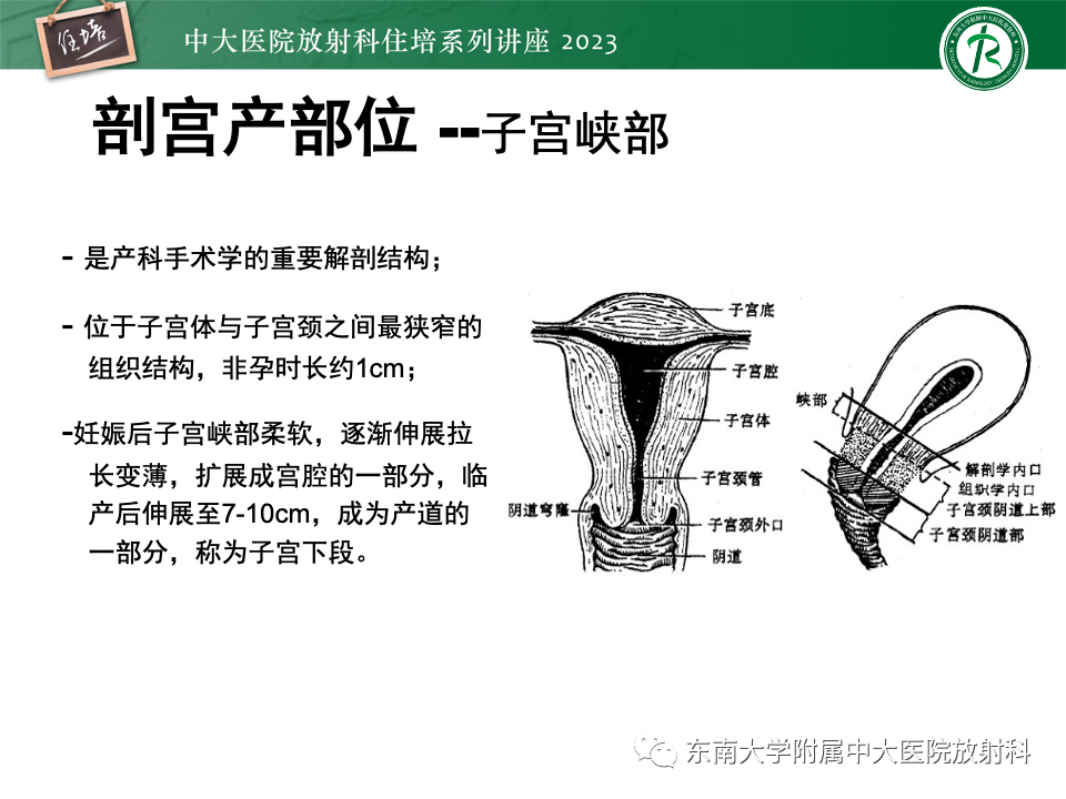 影像PPT - 【PPT】 剖宫产瘢痕妊娠-3