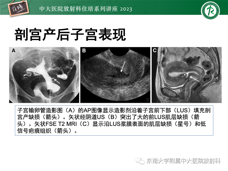 影像PPT - 【PPT】 剖宫产瘢痕妊娠-4