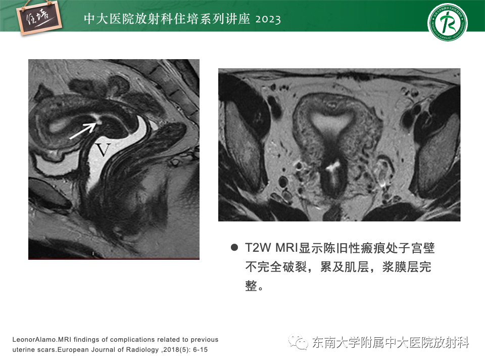 影像PPT - 【PPT】 剖宫产瘢痕妊娠-8