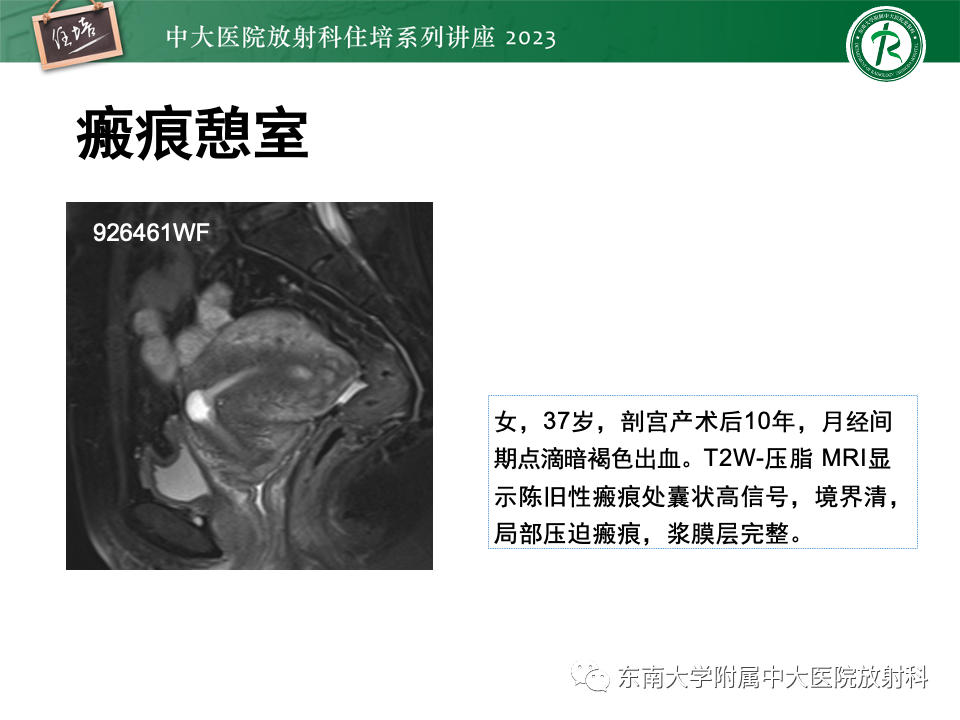 影像PPT - 【PPT】 剖宫产瘢痕妊娠-9