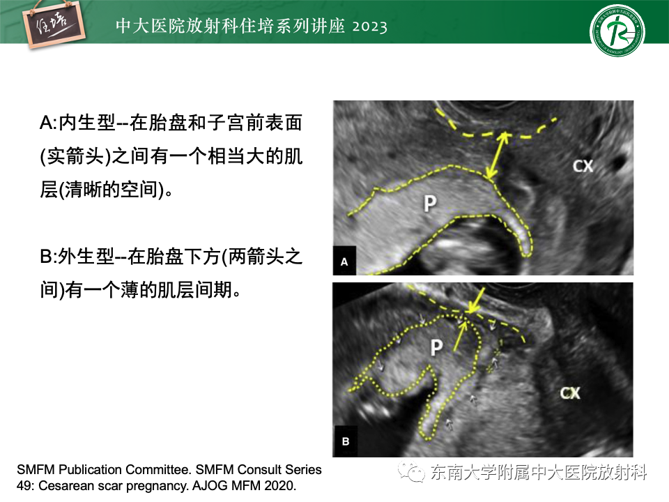 影像PPT - 【PPT】 剖宫产瘢痕妊娠-13