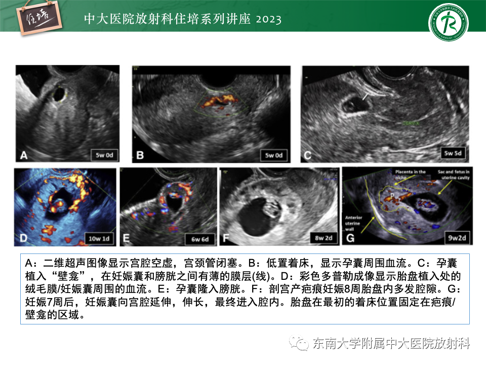影像PPT - 【PPT】 剖宫产瘢痕妊娠-15