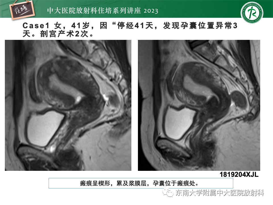 影像PPT - 【PPT】 剖宫产瘢痕妊娠-18
