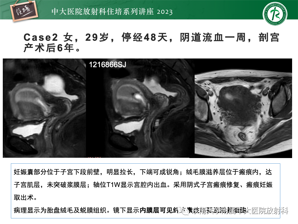 影像PPT - 【PPT】 剖宫产瘢痕妊娠-19