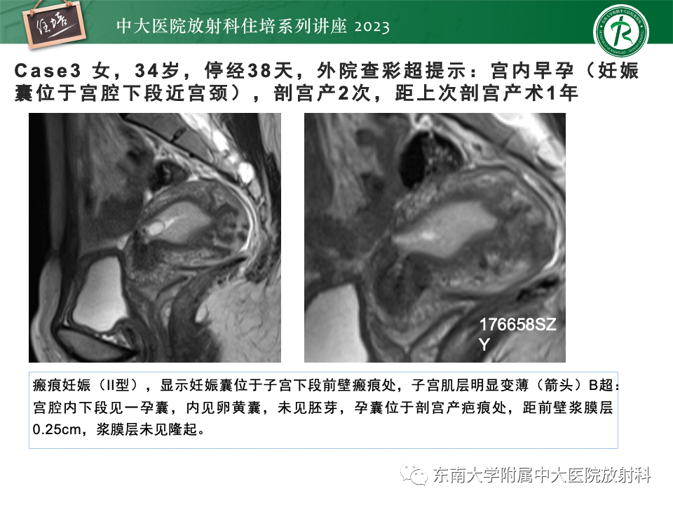 影像PPT - 【PPT】 剖宫产瘢痕妊娠-20