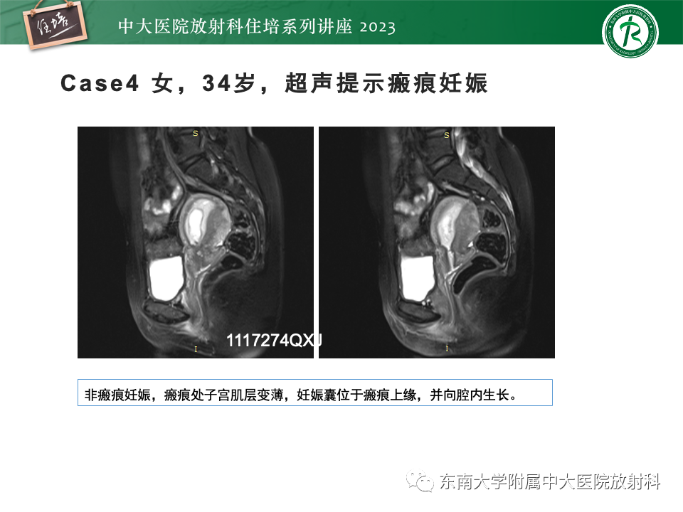 影像PPT - 【PPT】 剖宫产瘢痕妊娠-21