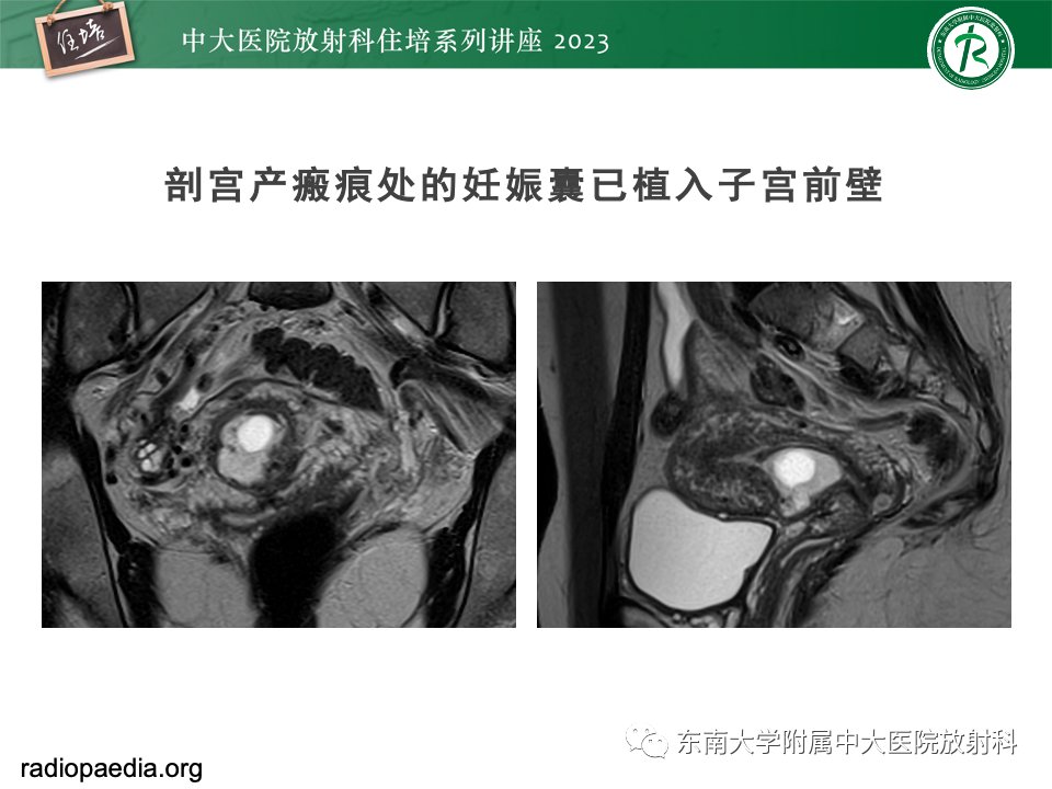 影像PPT - 【PPT】 剖宫产瘢痕妊娠-22