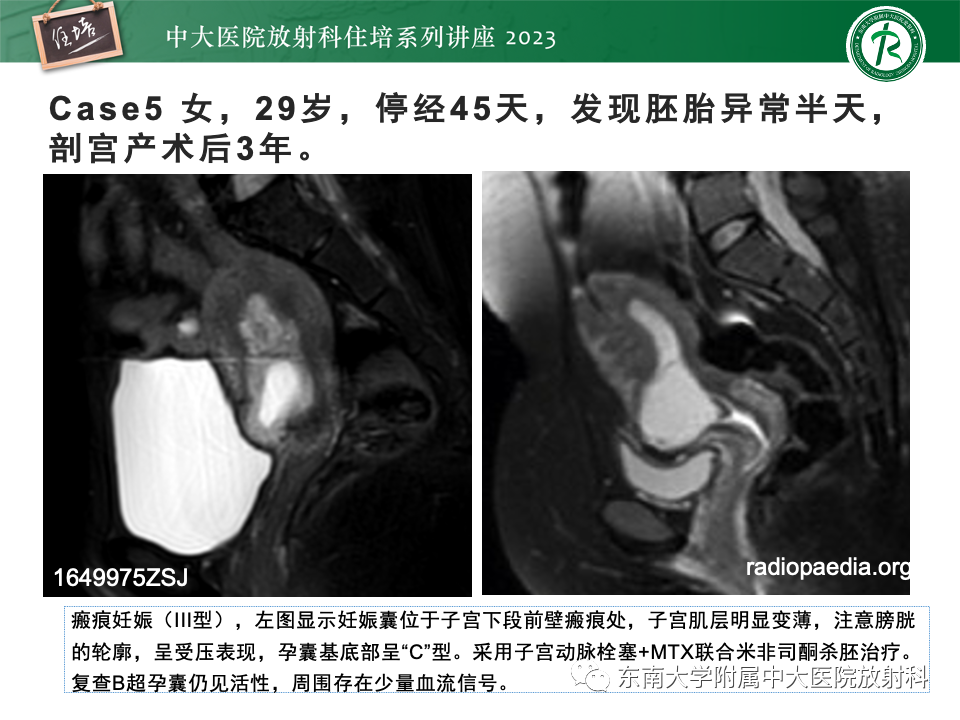影像PPT - 【PPT】 剖宫产瘢痕妊娠-23