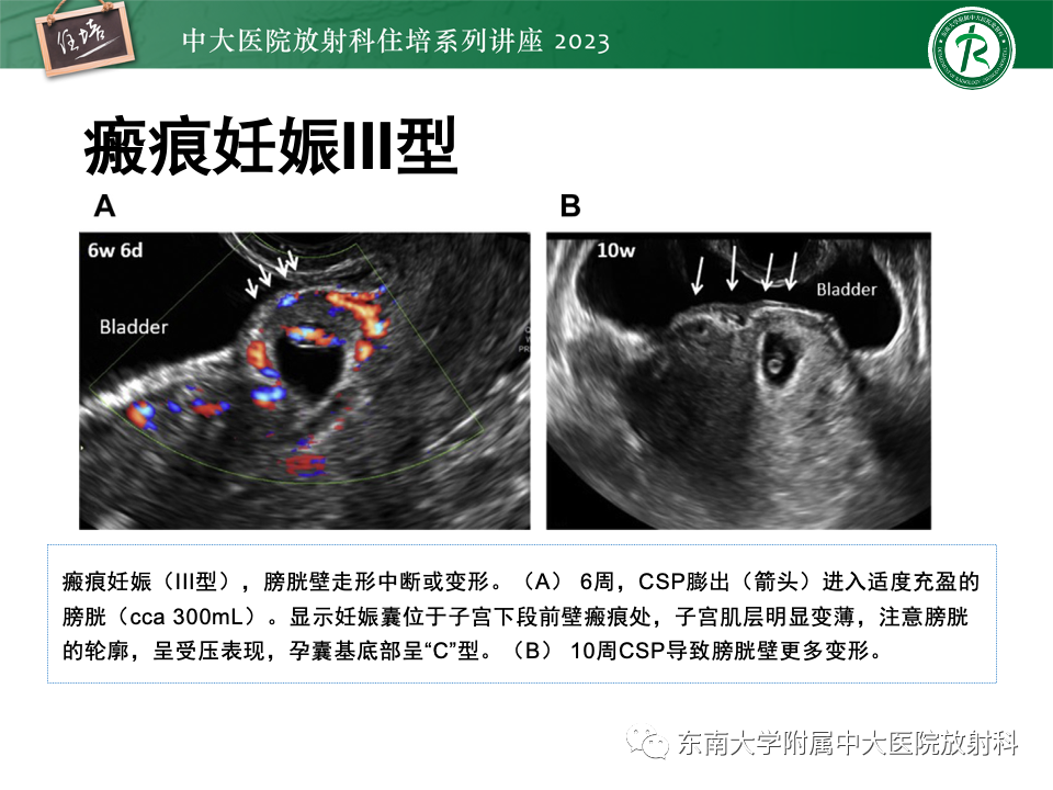 影像PPT - 【PPT】 剖宫产瘢痕妊娠-24
