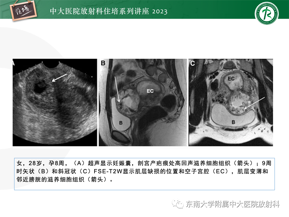 影像PPT - 【PPT】 剖宫产瘢痕妊娠-25