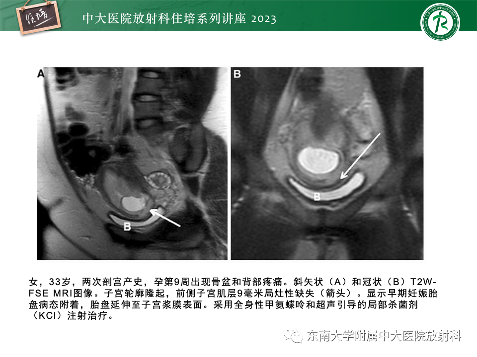 影像PPT - 【PPT】 剖宫产瘢痕妊娠-26