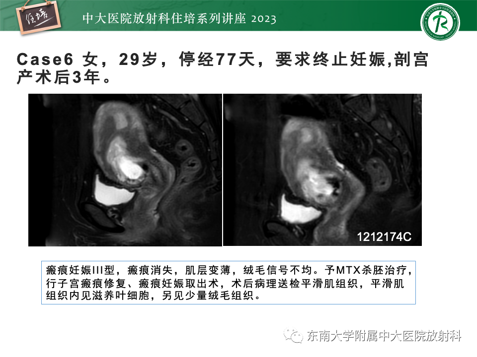 影像PPT - 【PPT】 剖宫产瘢痕妊娠-28