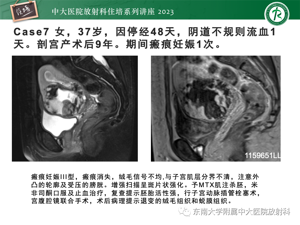 影像PPT - 【PPT】 剖宫产瘢痕妊娠-29