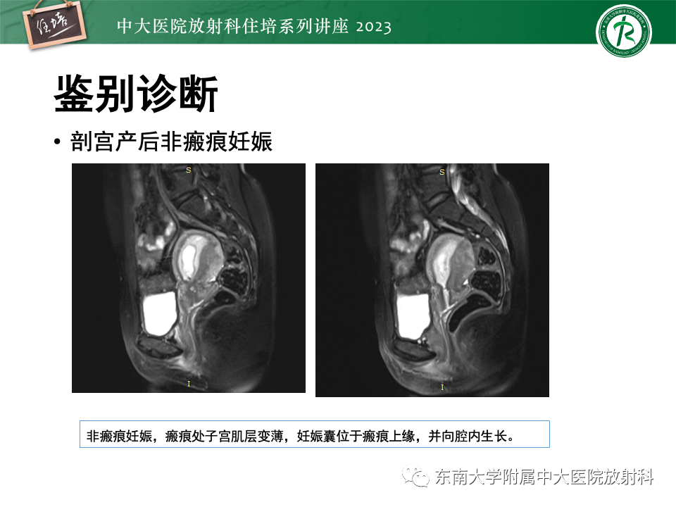 影像PPT - 【PPT】 剖宫产瘢痕妊娠-30