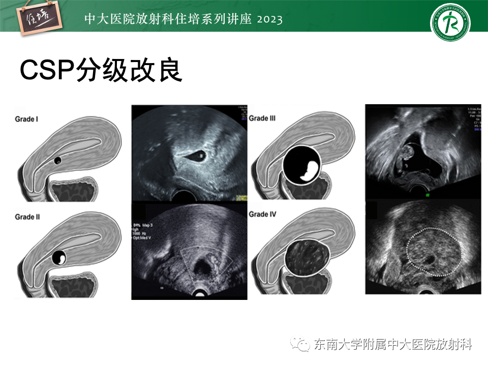 影像PPT - 【PPT】 剖宫产瘢痕妊娠-31