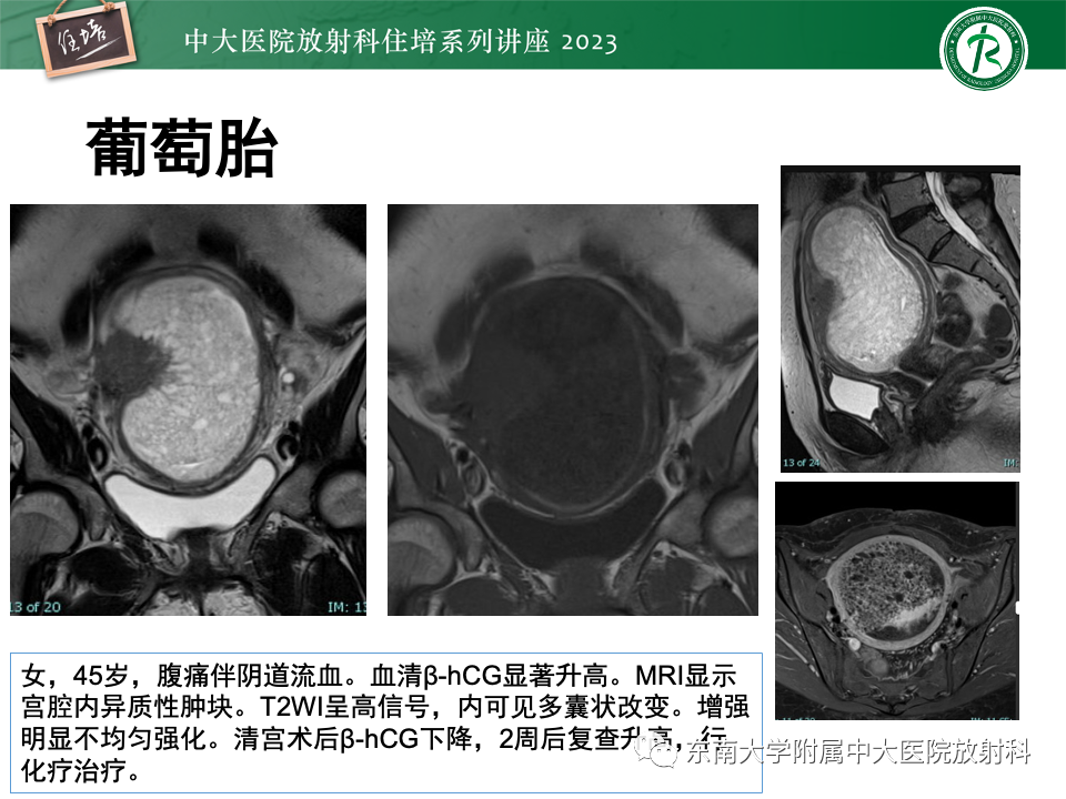 影像PPT - 【PPT】 剖宫产瘢痕妊娠-33