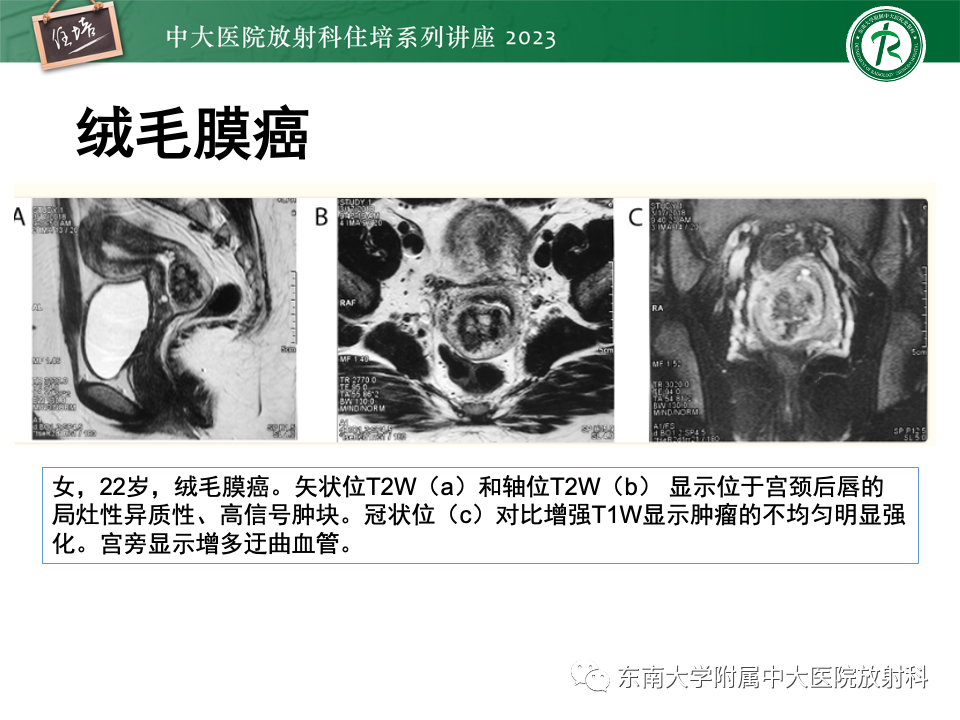 影像PPT - 【PPT】 剖宫产瘢痕妊娠-34