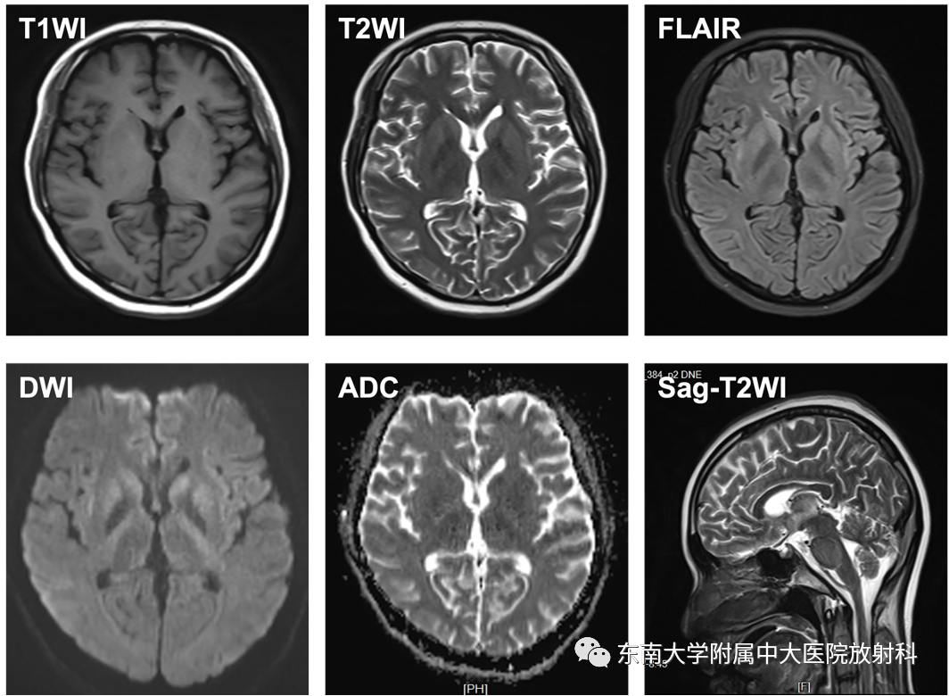影像PPT - 【PPT】渗透性脱髓鞘综合征-1