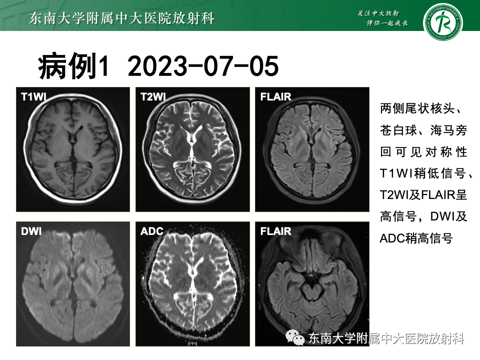 影像PPT - 【PPT】渗透性脱髓鞘综合征-5