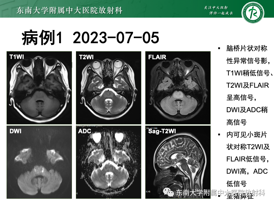 影像PPT - 【PPT】渗透性脱髓鞘综合征-4