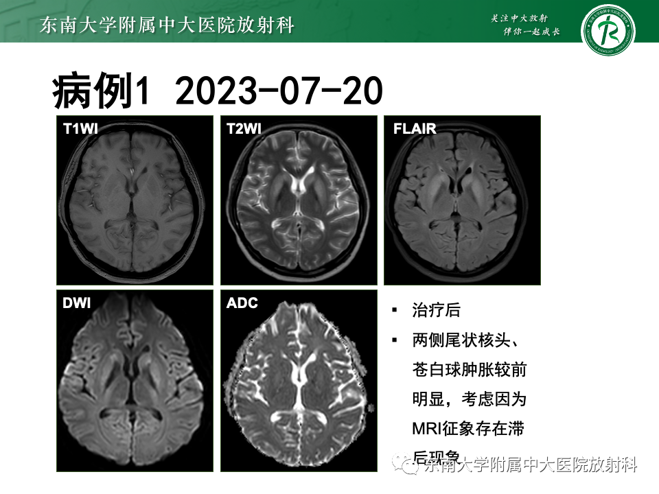 影像PPT - 【PPT】渗透性脱髓鞘综合征-7