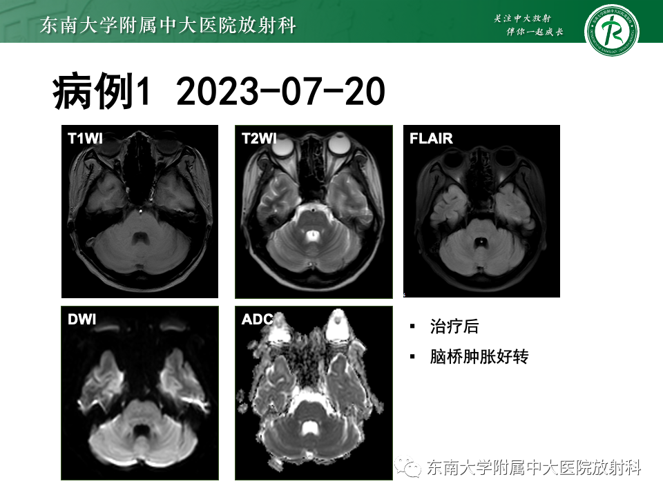 影像PPT - 【PPT】渗透性脱髓鞘综合征-8