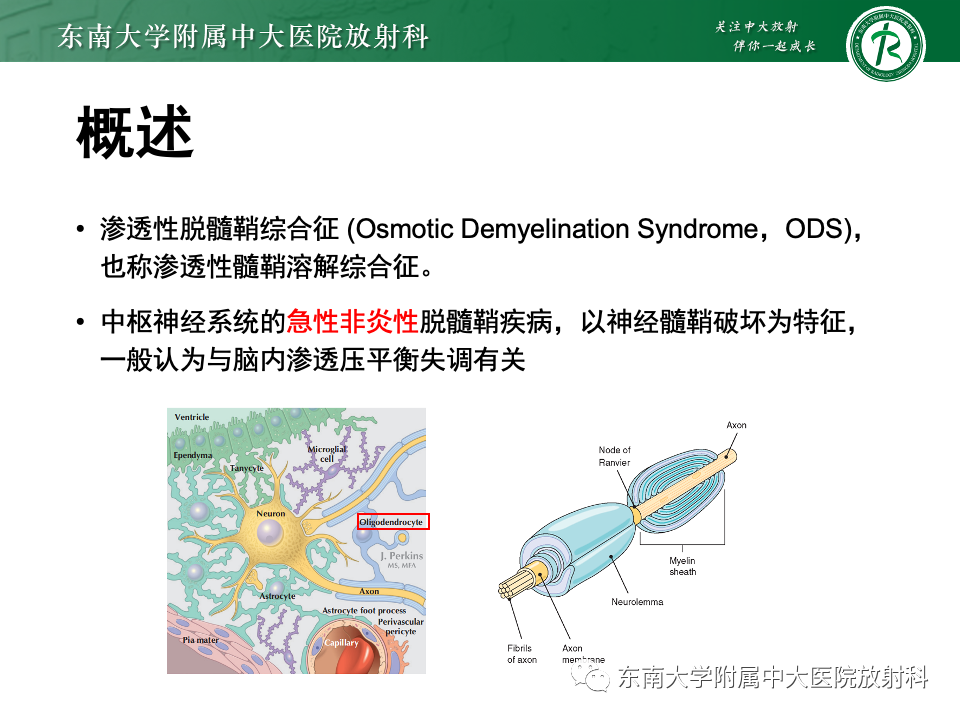 影像PPT - 【PPT】渗透性脱髓鞘综合征-10