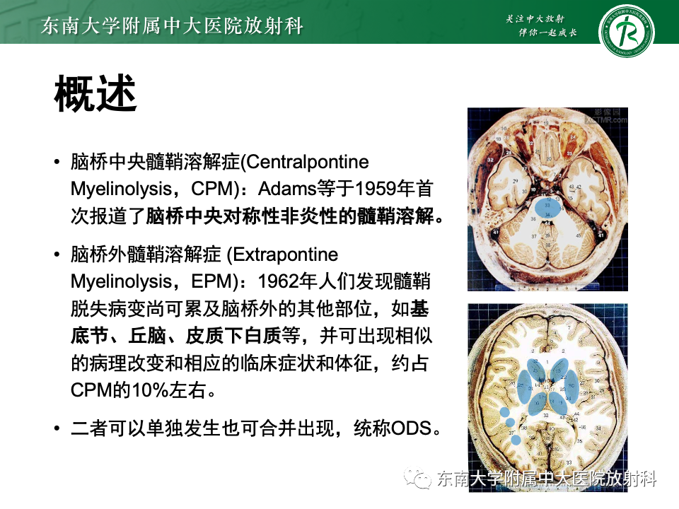 影像PPT - 【PPT】渗透性脱髓鞘综合征-11