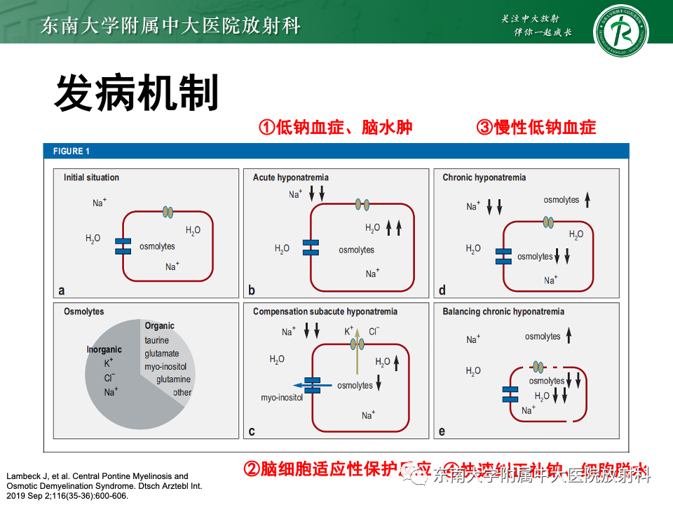 影像PPT - 【PPT】渗透性脱髓鞘综合征-14