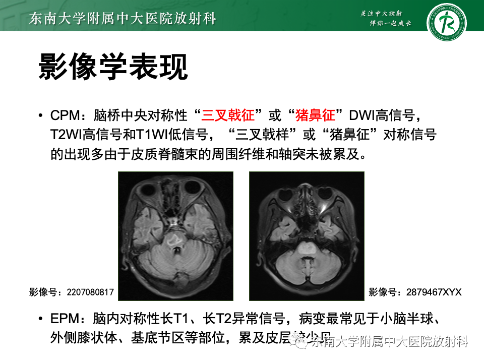 影像PPT - 【PPT】渗透性脱髓鞘综合征-18