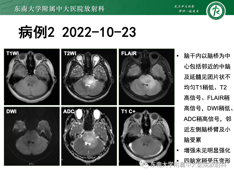 影像PPT - 【PPT】渗透性脱髓鞘综合征-23