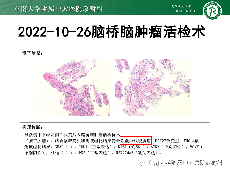 影像PPT - 【PPT】渗透性脱髓鞘综合征-24