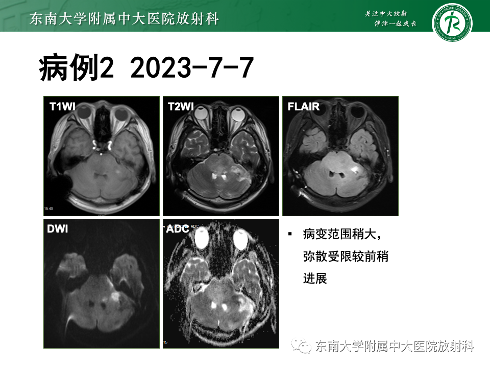 影像PPT - 【PPT】渗透性脱髓鞘综合征-25