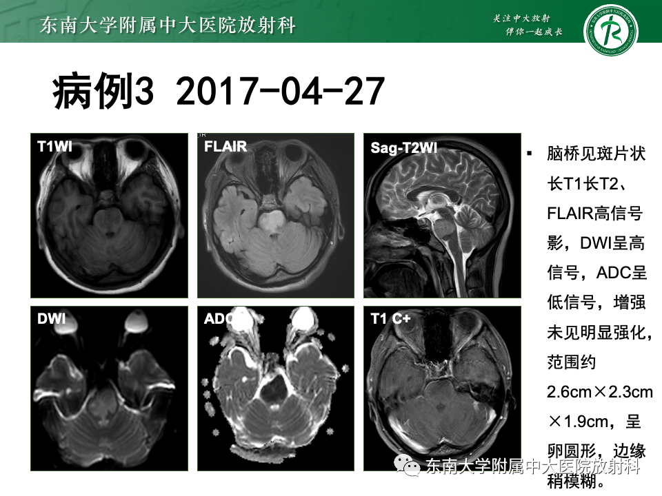 影像PPT - 【PPT】渗透性脱髓鞘综合征-29
