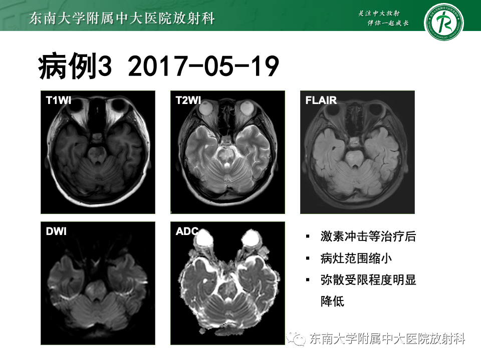 影像PPT - 【PPT】渗透性脱髓鞘综合征-31