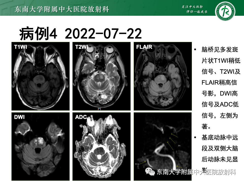 影像PPT - 【PPT】渗透性脱髓鞘综合征-35