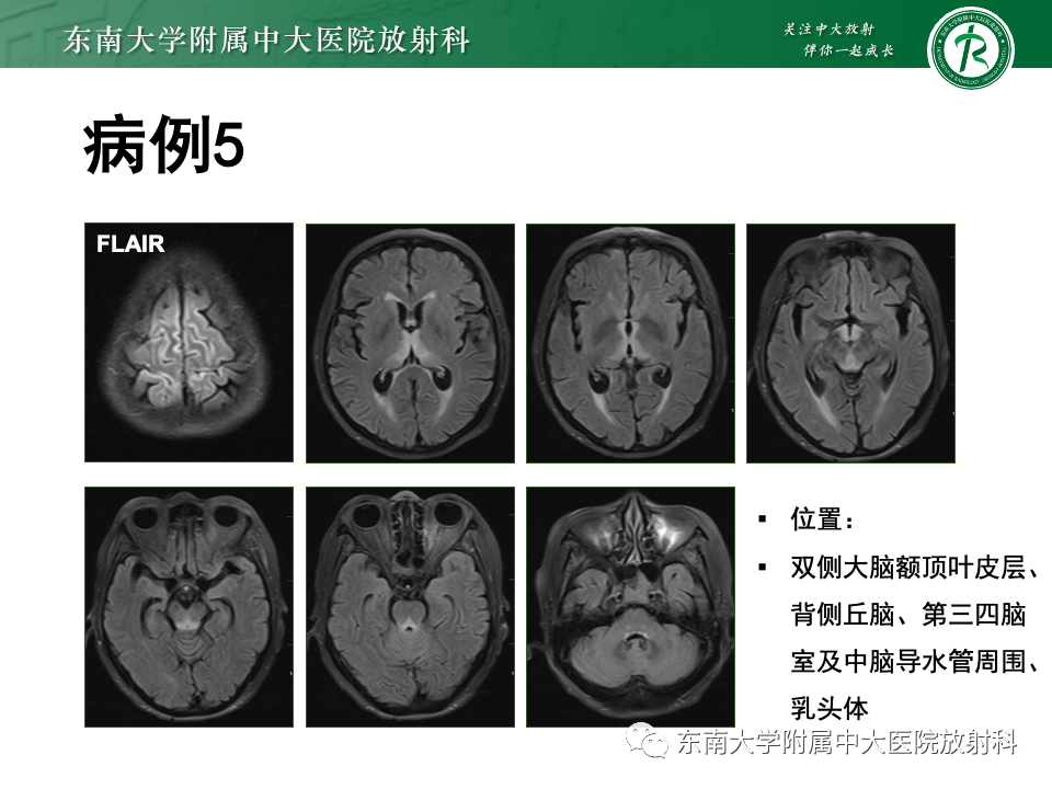 影像PPT - 【PPT】渗透性脱髓鞘综合征-38