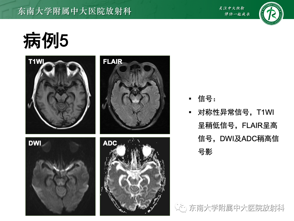 影像PPT - 【PPT】渗透性脱髓鞘综合征-39