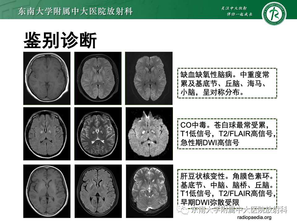 影像PPT - 【PPT】渗透性脱髓鞘综合征-41
