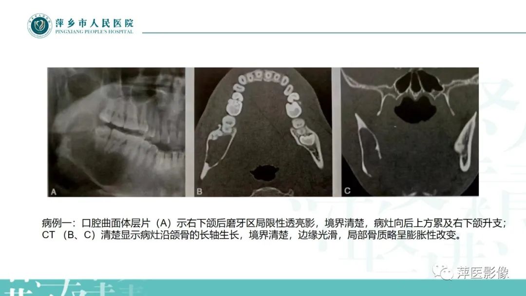 影像PPT - 【PPT】浅谈颌骨常见囊性病变-6