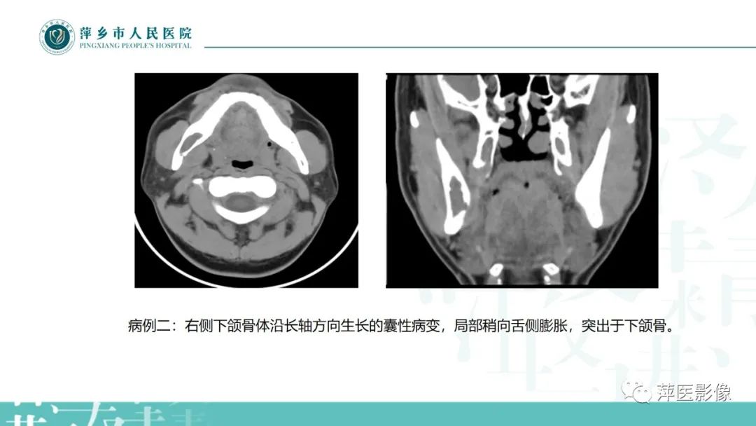 影像PPT - 【PPT】浅谈颌骨常见囊性病变-7