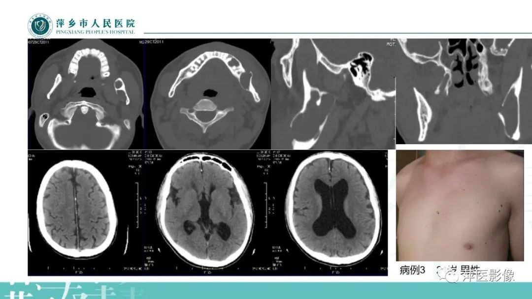 影像PPT - 【PPT】浅谈颌骨常见囊性病变-8