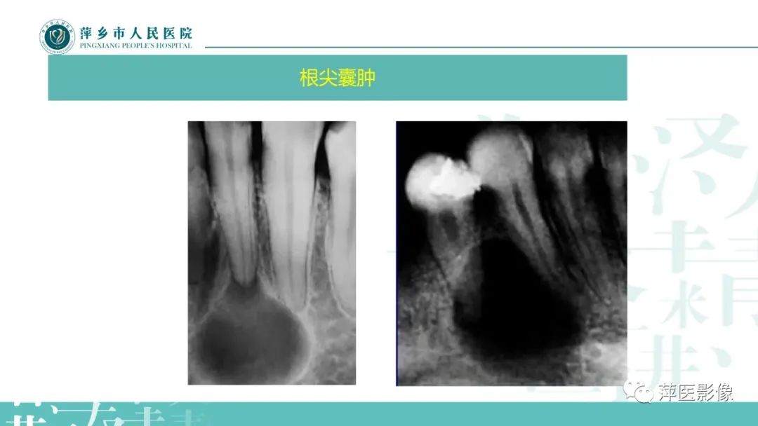 影像PPT - 【PPT】浅谈颌骨常见囊性病变-11
