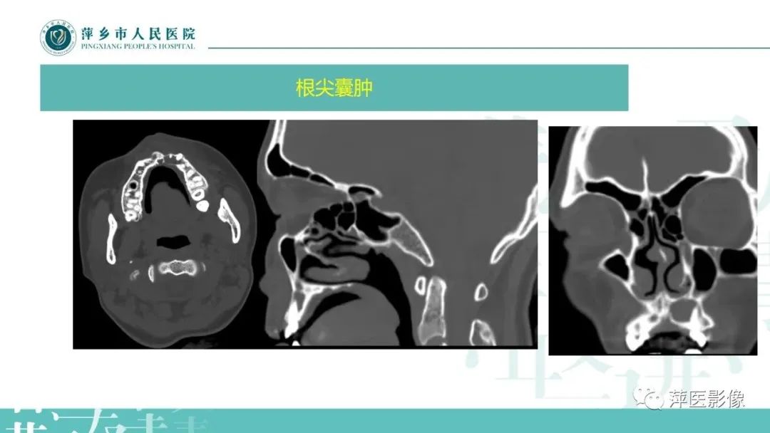 影像PPT - 【PPT】浅谈颌骨常见囊性病变-12