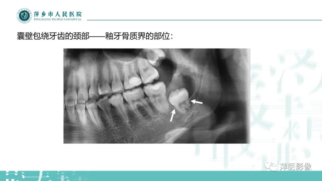 影像PPT - 【PPT】浅谈颌骨常见囊性病变-15