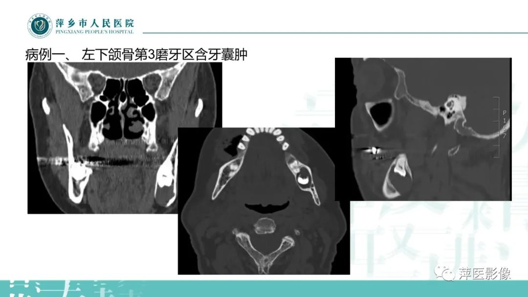影像PPT - 【PPT】浅谈颌骨常见囊性病变-16
