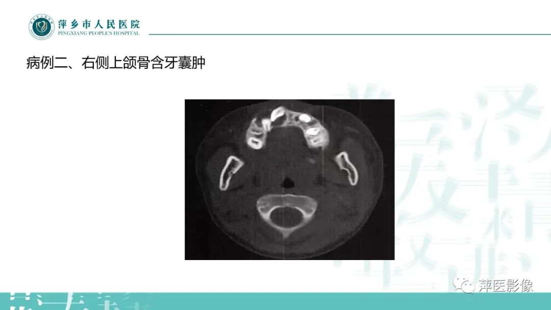 影像PPT - 【PPT】浅谈颌骨常见囊性病变-17