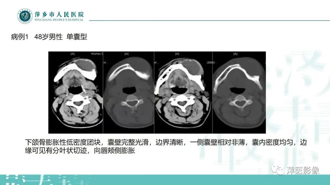影像PPT - 【PPT】浅谈颌骨常见囊性病变-21