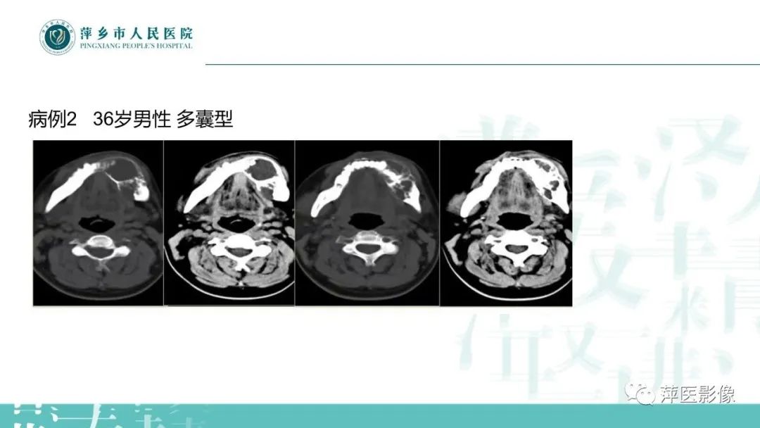 影像PPT - 【PPT】浅谈颌骨常见囊性病变-22